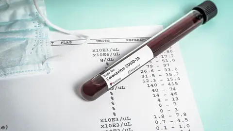 Hand holds a test tube containing a blood sample, test tube  for Covid-19 (coronavirus) analyzing. Laboratory testing patient’s sample