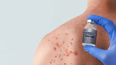 MPOX VIRUELA DEL MONO