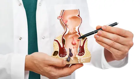 cribado colon cáncer colorrectal